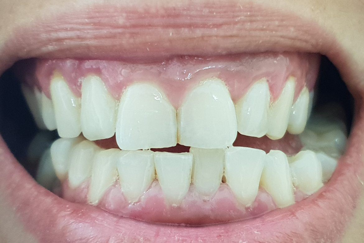 תוצאה סופית - שן מחרסינה מלאה בהתאמת צבע אישית