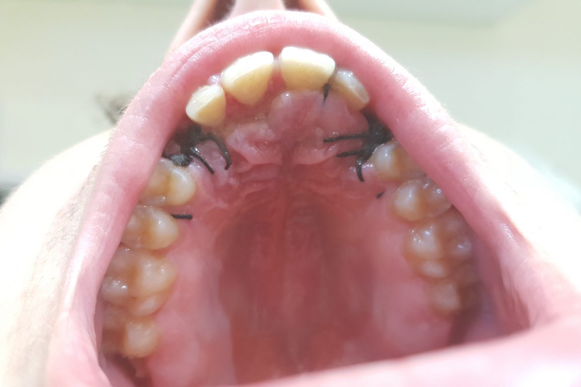 וינטרמן רפואה וטכנאות שיניים - עקירה והשתלה