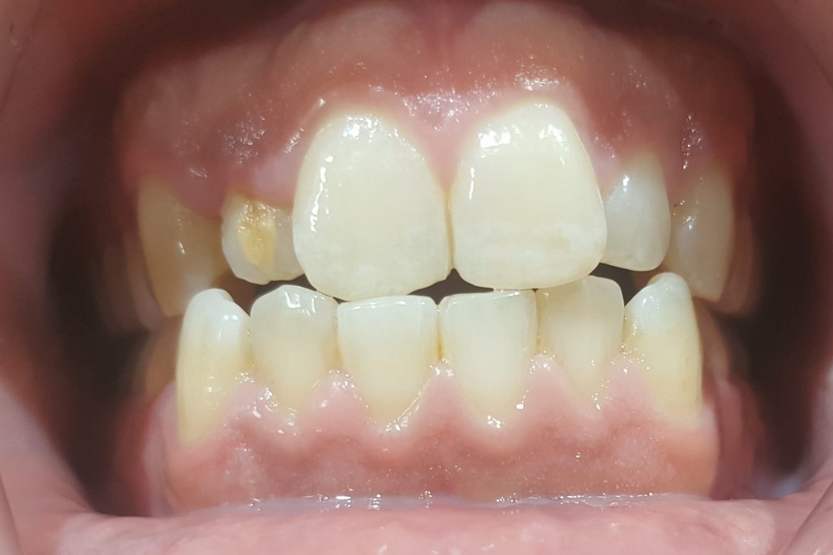 קליניקת וינטרמן - שתלים, רפואה וטכנאות שיניים בחיפה - ציפוי חרסינה בשן קדמית עם פגם התפתחותו מולד