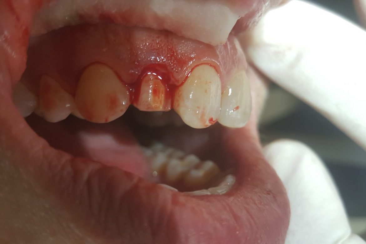 קליניקת וינטרמן - שתלים, רפואה וטכנאות שיניים בחיפה-תיקון פגם מולד בשן קדמית