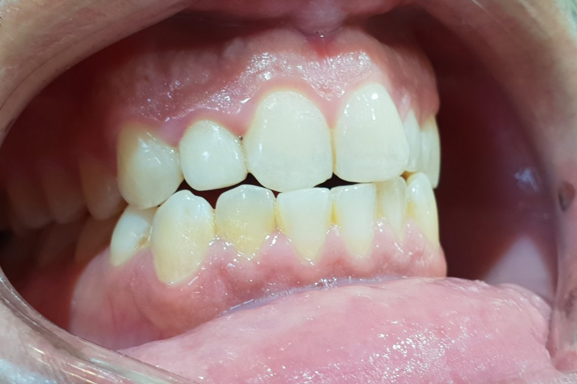 קליניקת וינטרמן - שתלים, רפואה וטכנאות שיניים בחיפה - תיקון פגם מולד בשן קדמית