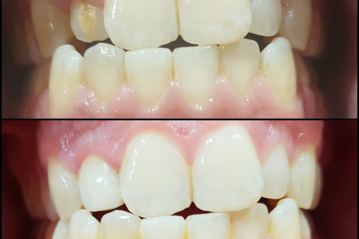 קליניקת וינטרמן - שתלים, רפואה וטכנאות שיניים בחיפה - תיקון פגם מולד בשן קדמית