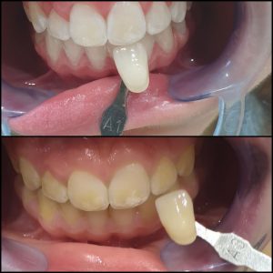 קליניקת וינטרמן - הבהרת שיניים