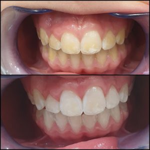 קליניקת וינטרמן - הבהרת שיניים