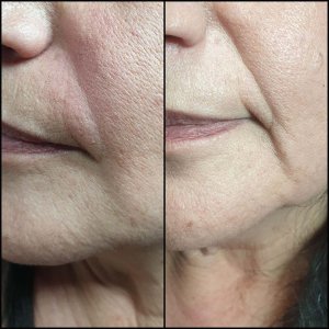 חומצה היאלורונית - שחזור נפחים