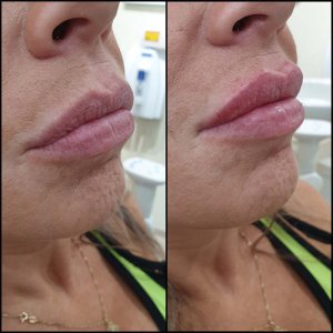 חומצה היאלורונית - עיצוב שפתיים
