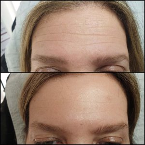 בוטוקס העלמת קמטים במצח