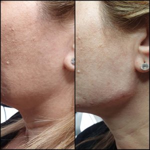 חומצה היאלורונית - קו לסת