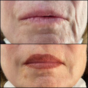 חומצה היאלורונית - שחזור נפחים