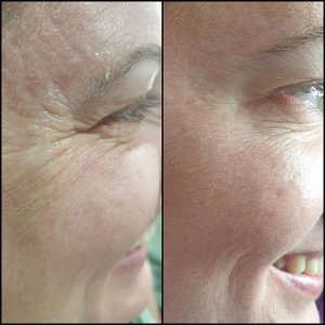 בוטוקס העלמת קמטים בצידי העיניים