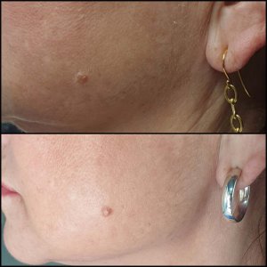 חומצה היאלורונית - קו לסת