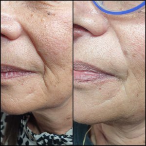 חומצה היאלורונית - שחזור נפחים