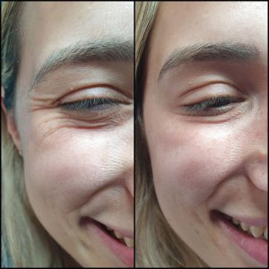 טיפול בוטוקס בצידי העיניים