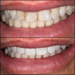 שיקום שיניים בעזרת ציפויי חרסינה בהתאמת צבע אישית