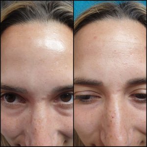 טיפול בוטוקס במצח